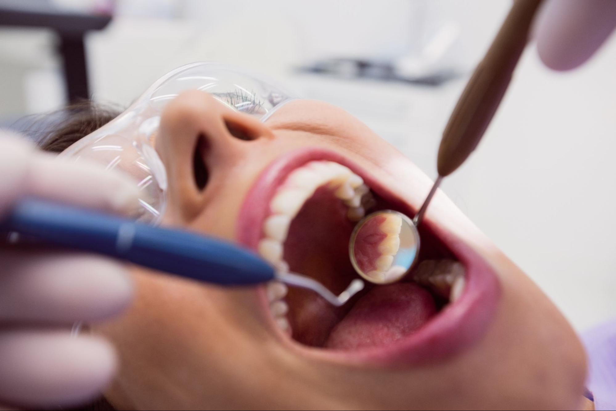 Лечение кариеса с постановкой пломбы световой полимеризации «Filtek», «Esthet»  (анестезия, формирование полости, постановка пломбы, полировка)